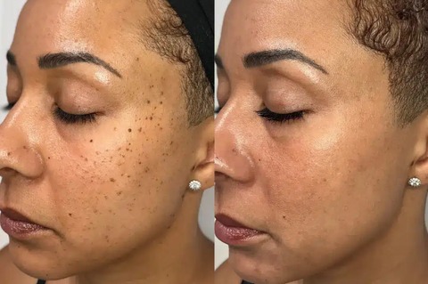 Non-Invasive Mole and Wart Removal Laser Pen image Non-Invasive Mole and Wart Removal Laser Pen