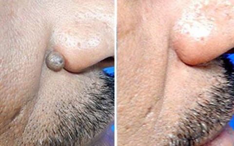 Non-Invasive Mole and Wart Removal Laser Pen image Non-Invasive Mole and Wart Removal Laser Pen