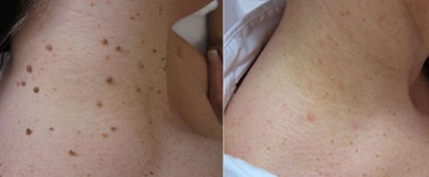 Non-Invasive Mole and Wart Removal Laser Pen image Non-Invasive Mole and Wart Removal Laser Pen