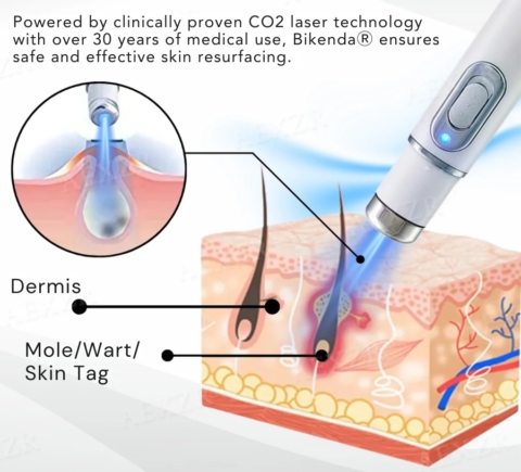 Non-Invasive Mole and Wart Removal Laser Pen image Non-Invasive Mole and Wart Removal Laser Pen