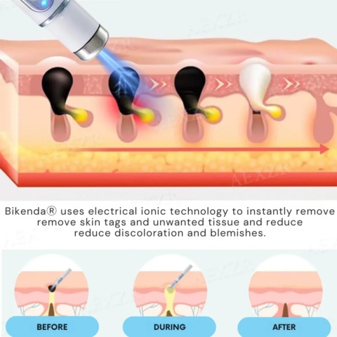 Non-Invasive Mole and Wart Removal Laser Pen image Non-Invasive Mole and Wart Removal Laser Pen
