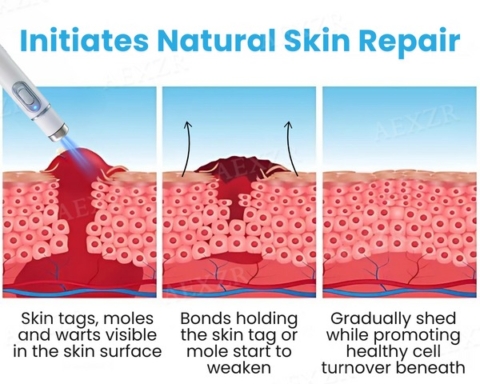 Non-Invasive Mole and Wart Removal Laser Pen image Non-Invasive Mole and Wart Removal Laser Pen